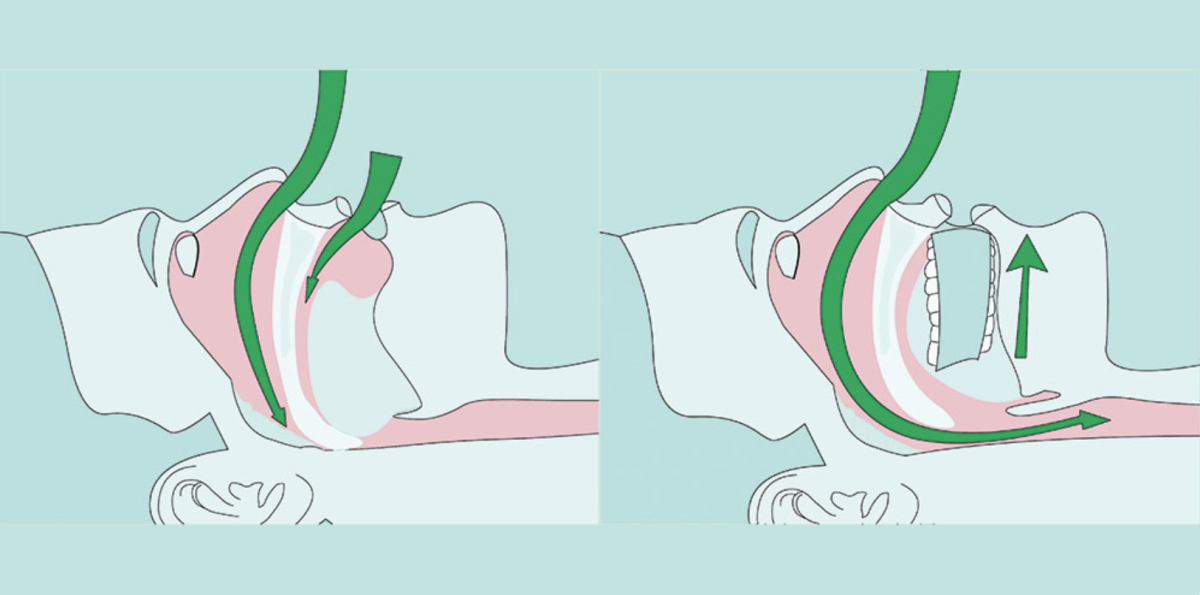 horlama ve uyku apnesi tedavisi