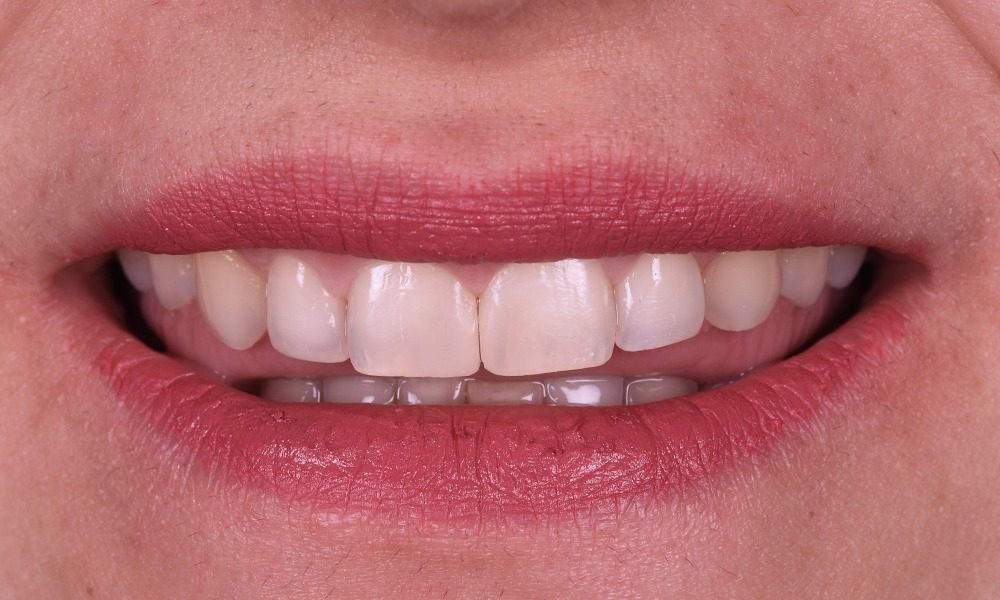 Bonding Uygulaması (Diastema Kapama)