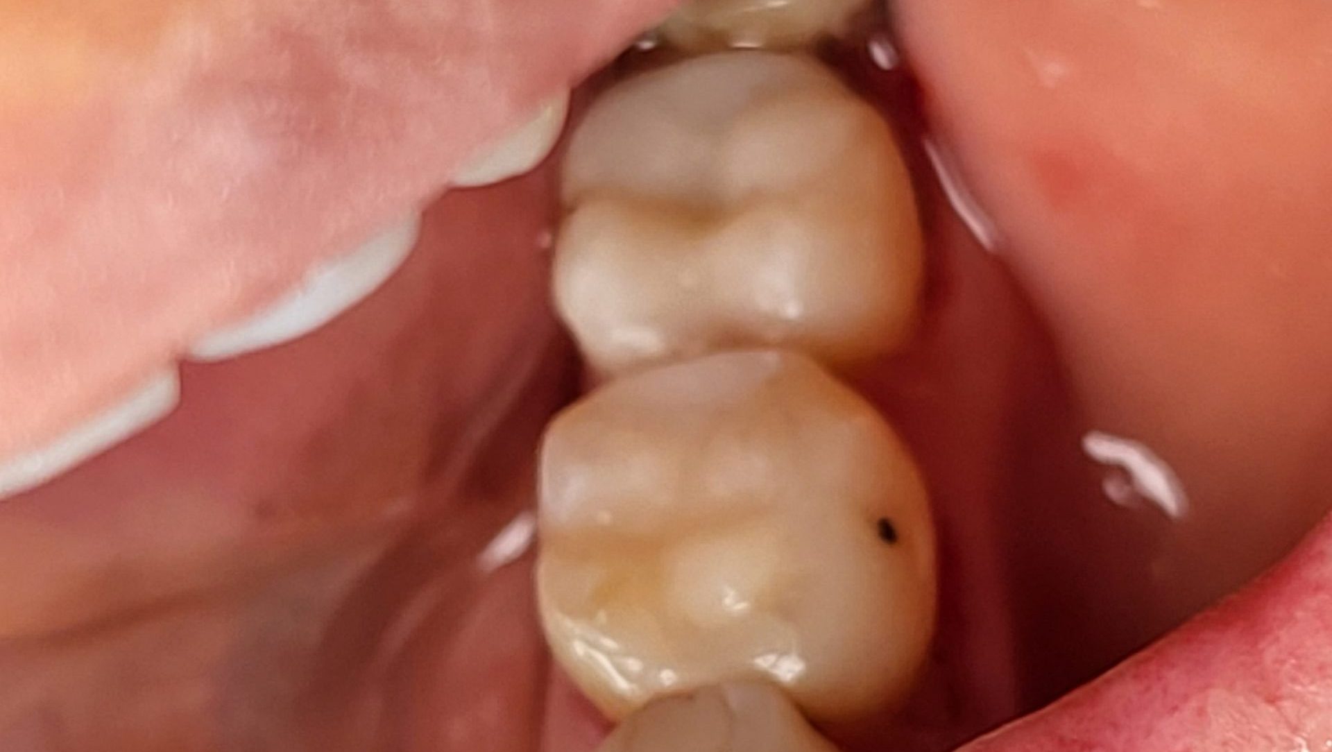 Estetik Kompozit Dolgu