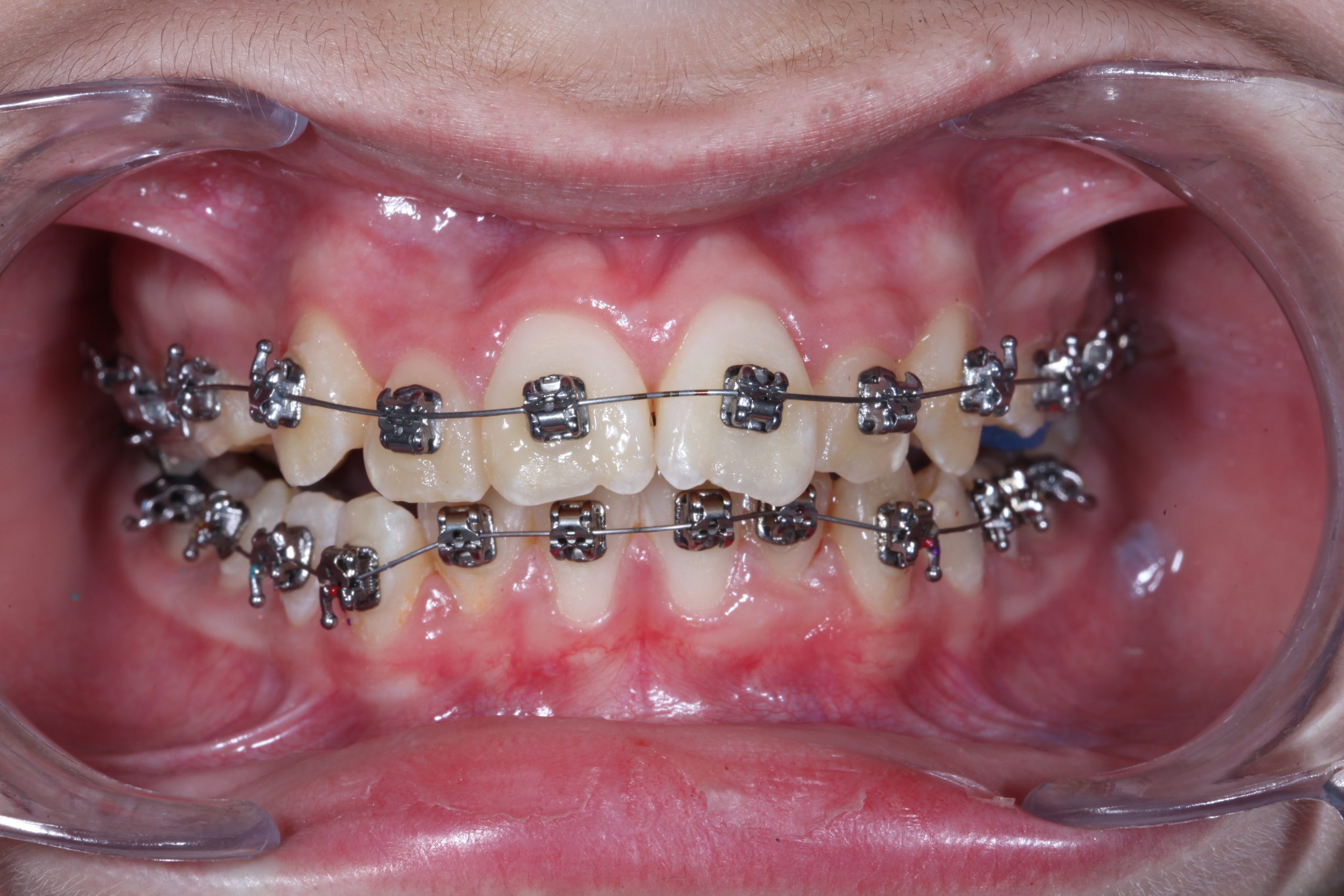 Metal-Seramik (Şeffaf) Braketler