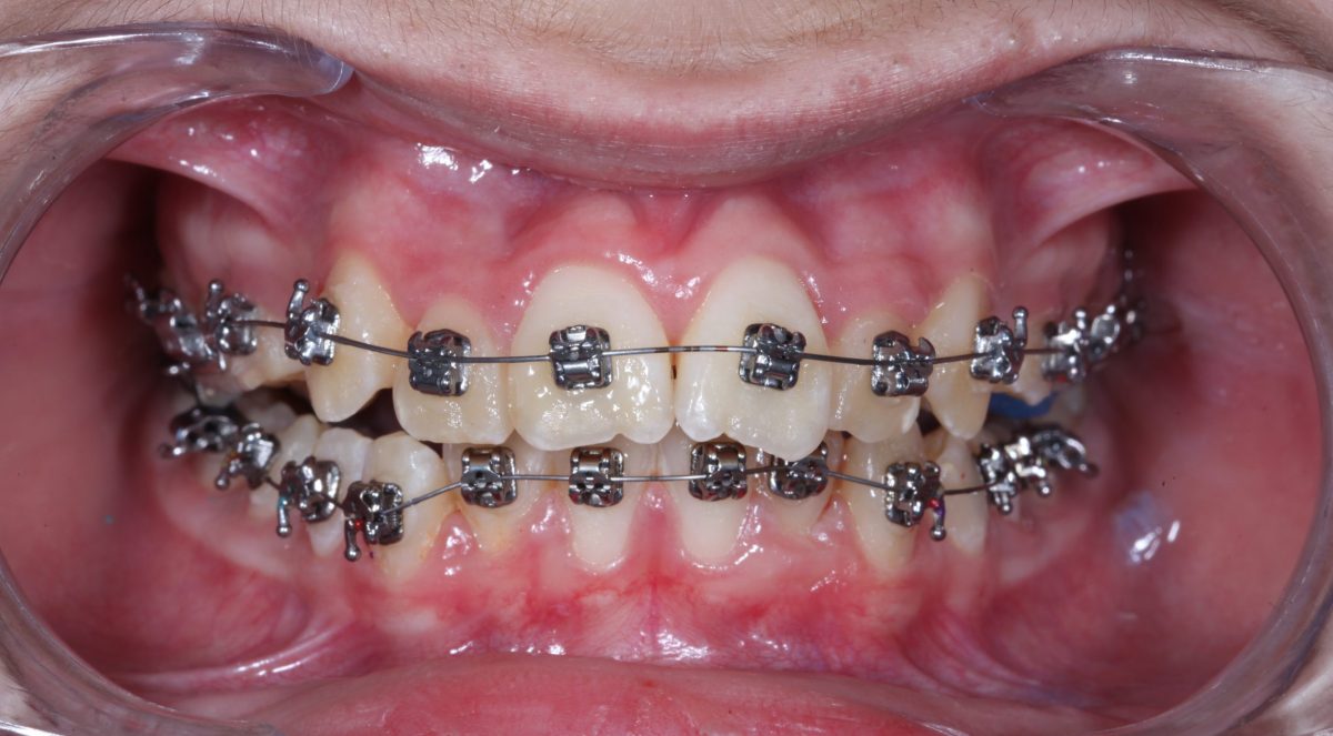 ortodonti tedavisi görseli