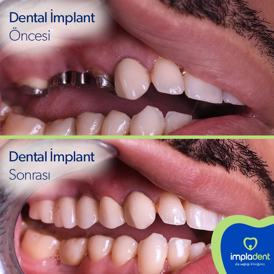 Dental Implant İmpladent