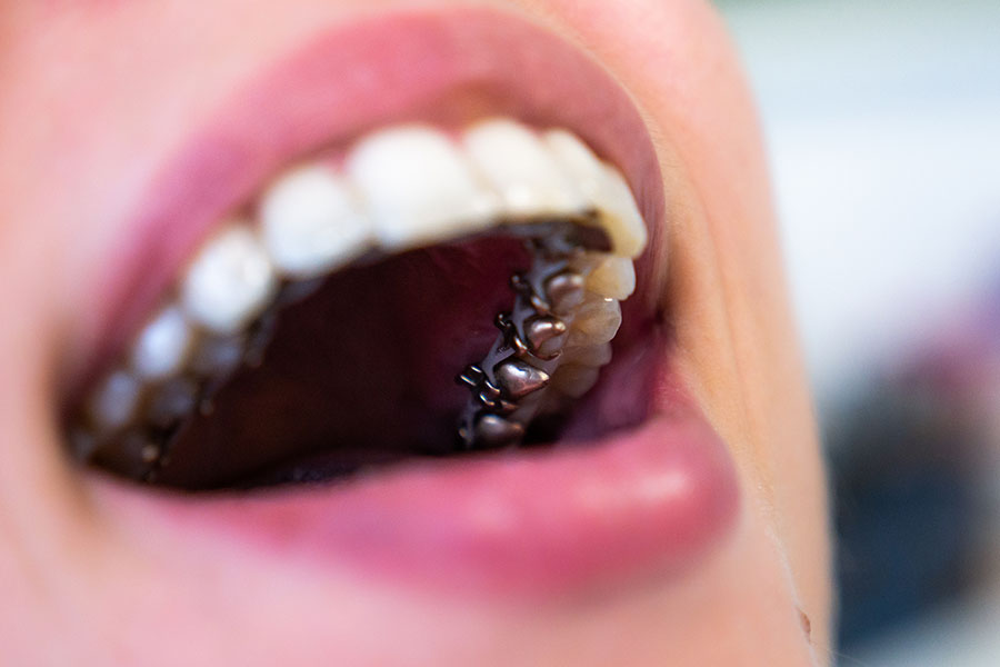 Lingual Ortodontik Tedavi (Görünmeyen Tel)