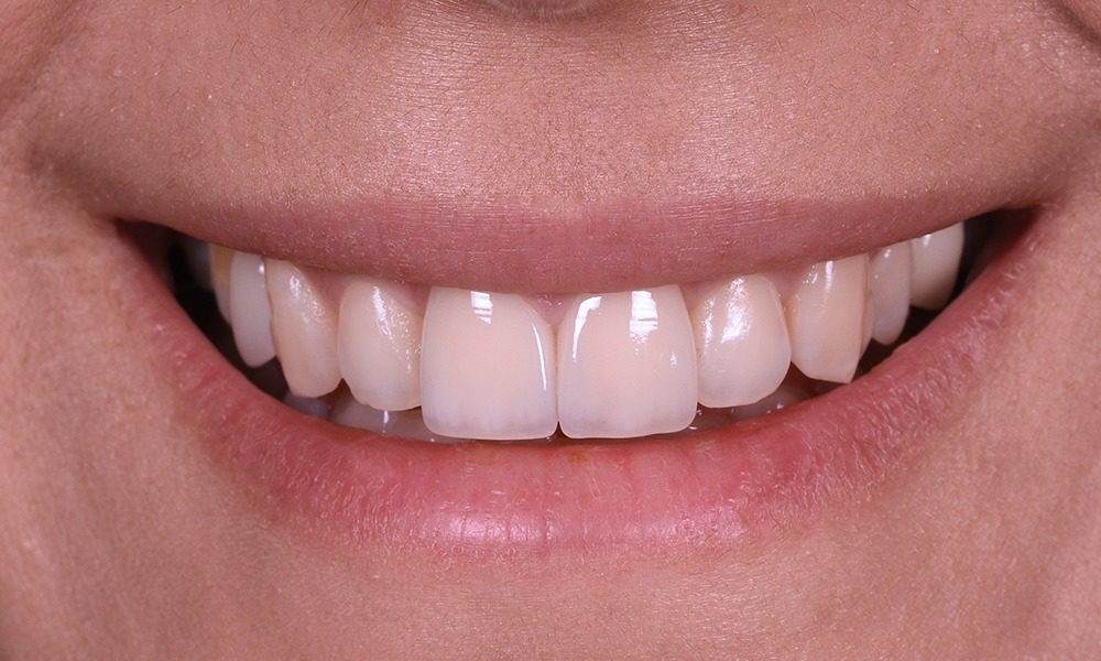 Porselen Laminalar (Yaprak Porselen)