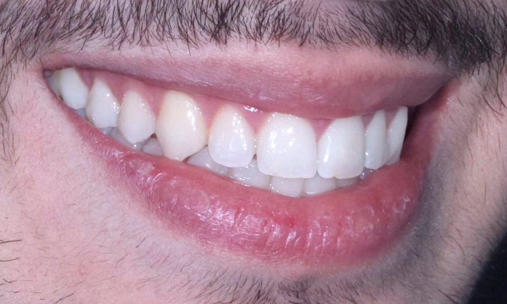 Şeffaf Plaklar İle Ortodontik Tedavi